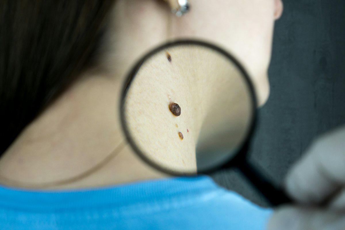 Close examination of a small skin growth with a magnifying glass