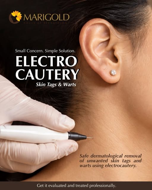 Instagram post: Electrocautery for skin tags & warts